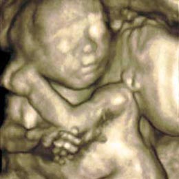 Image:3d ultrasound